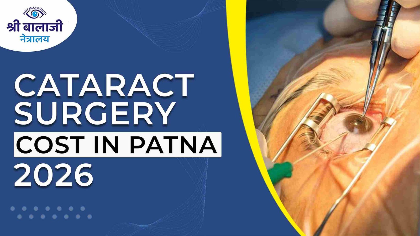 Cataract Surgery Cost in Patna